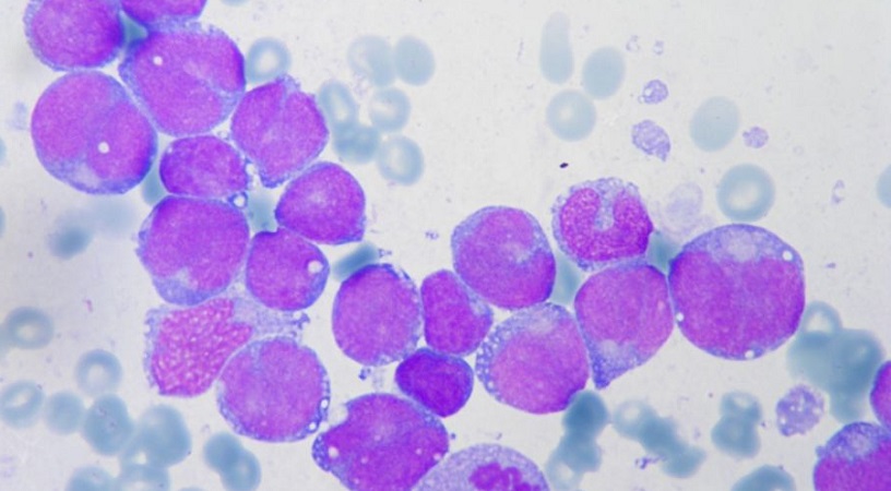 Blastos de Leucemia