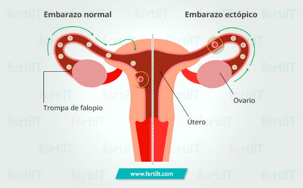 Embarazo ectopico Fertilt