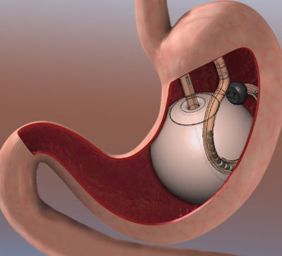 Balon gastrico infografia