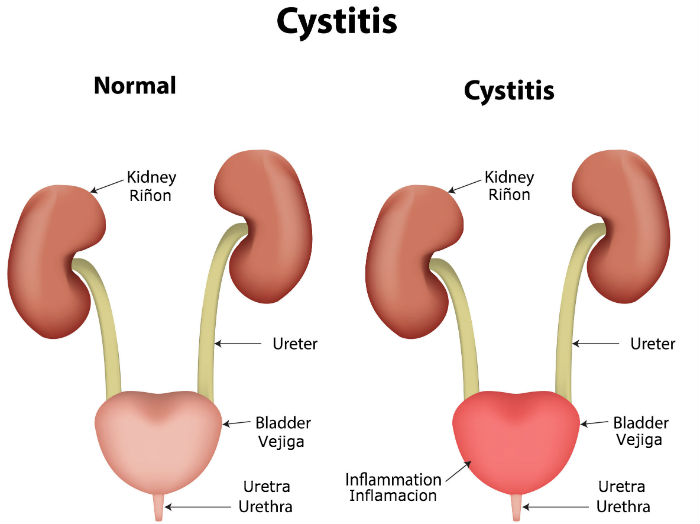 Infografia Sintomas de la Cistitis