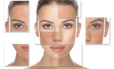 7 Recomendaciones para tratar el acne