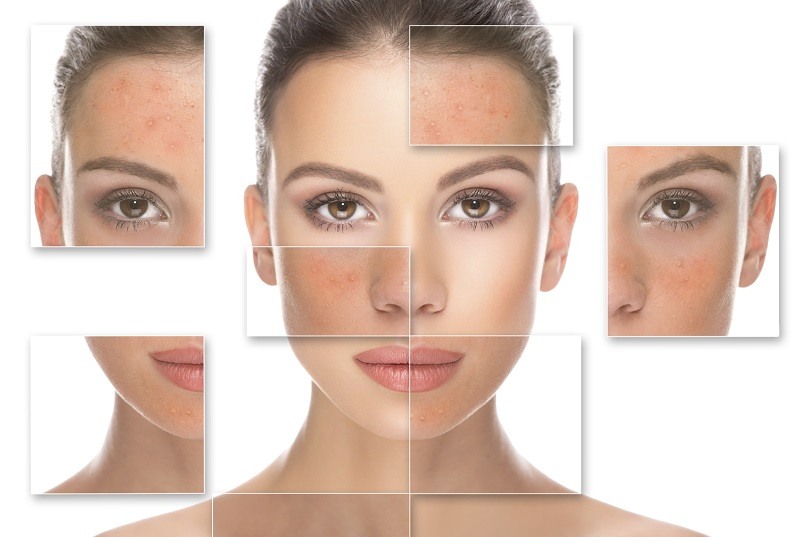 7 Recomendaciones para tratar el acne