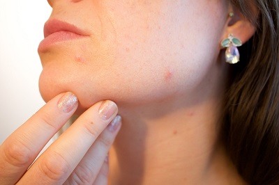 Cuidados para eliminar el acne