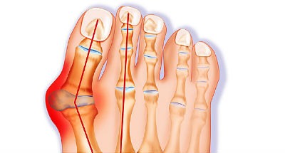 Hallux Valgus