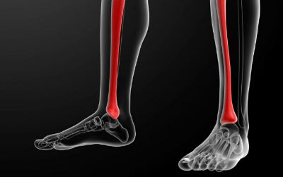 Periostitis tibial