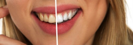 Consigue Unos Dientes Blancos y Perfectos