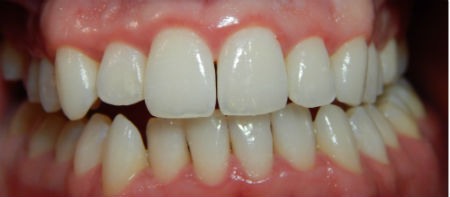 Tratamiento de la gingivitis