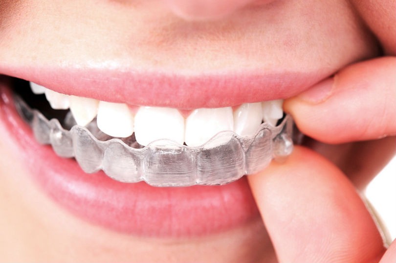 Ortodoncia invisalign