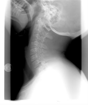 Lesión cervical