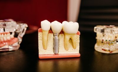 Tipos de prótesis dentales