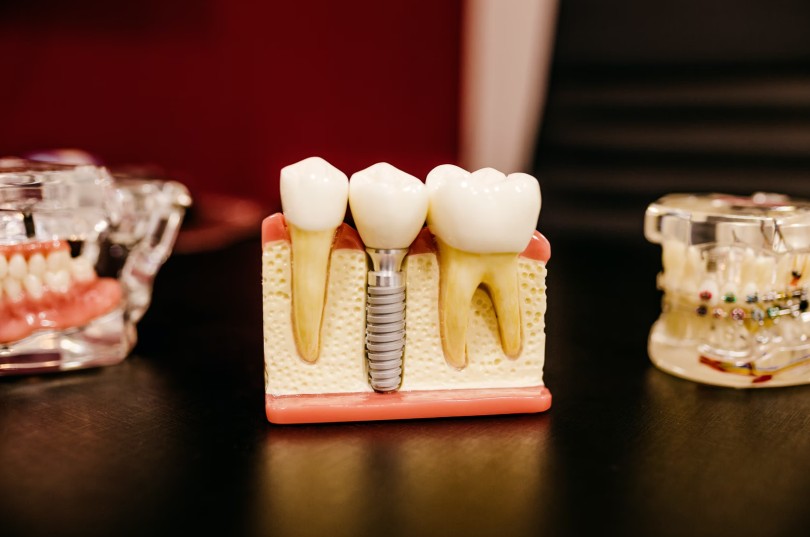 Tipos de prótesis dentales