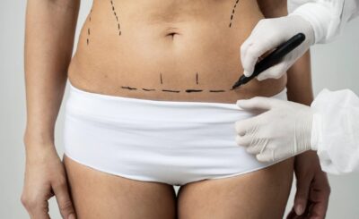 Abdominoplastia