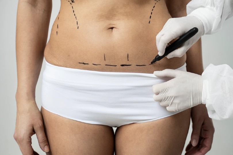 Abdominoplastia