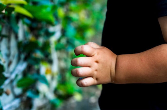 Obesidad infantil
